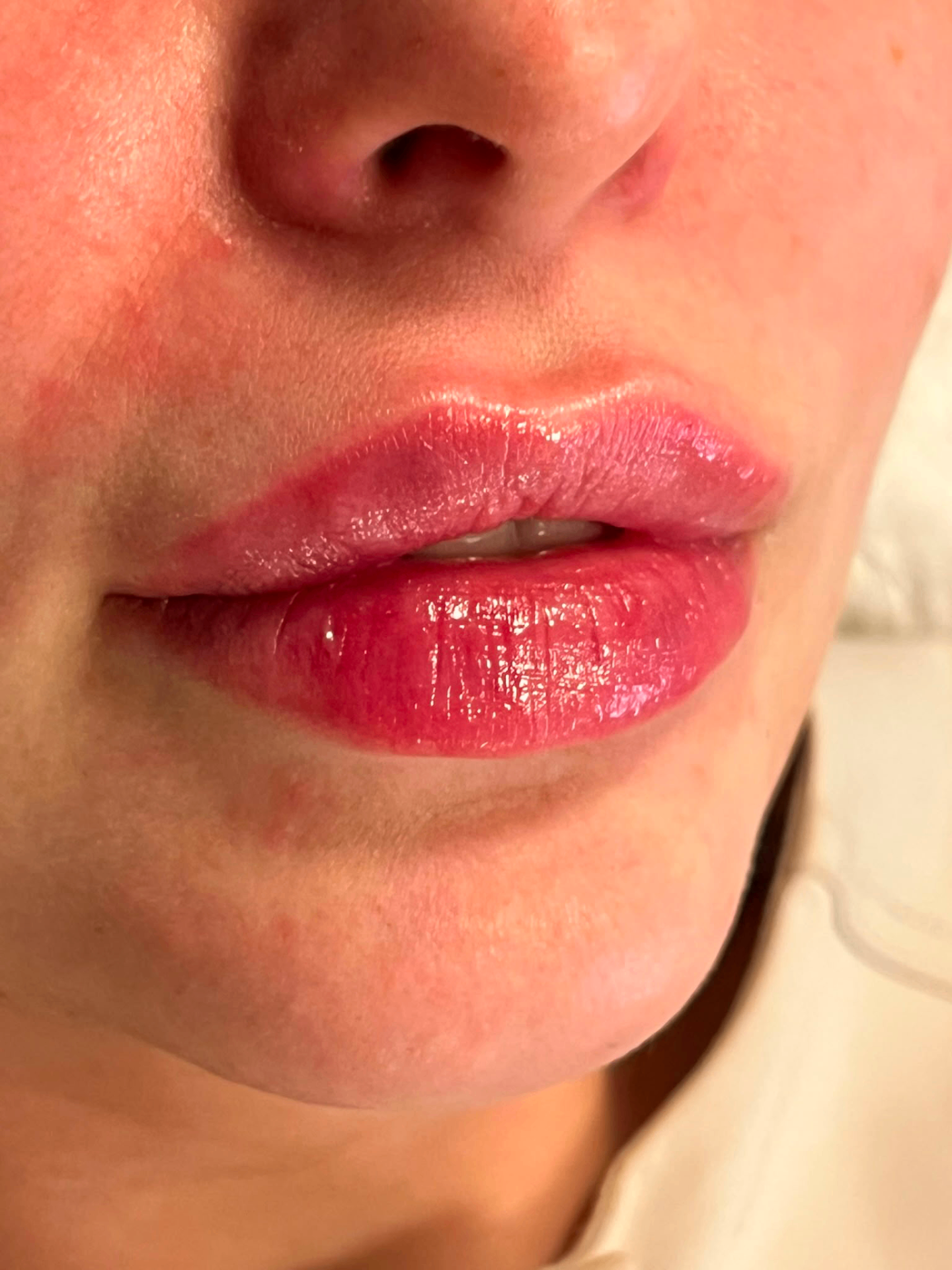 Naturlig leppefiller hos Glow To Go Bergen
